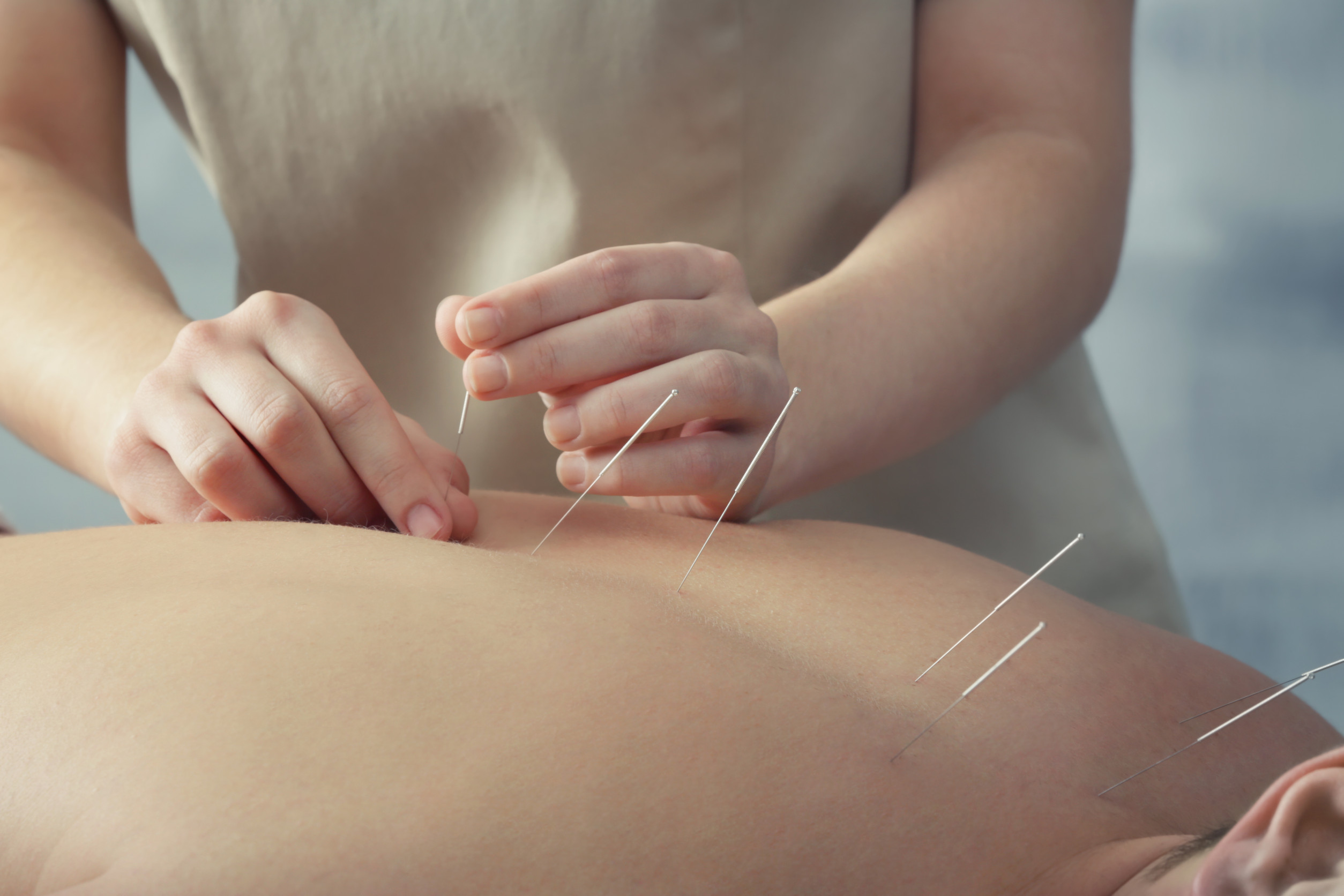 Young man getting acupuncture treatment, closeup