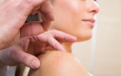 Top Benefits of Acupuncture for Managing Digestive Issues
